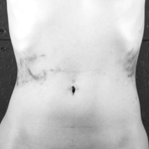Bruise